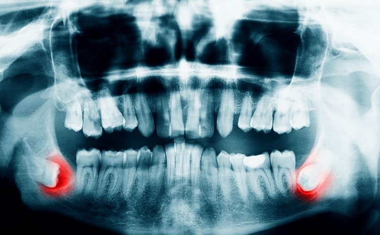 Ząb zatrzymany – co to jest Przyczyny, sposoby leczenia